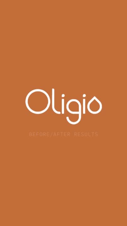 Oligio.us on LinkedIn: #oligio #radiofrequency #aestheticmedicine