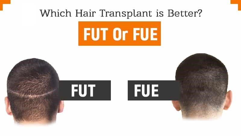 What are FUT and FUE? Why do Surgeons Recommend PRP after Hair Transplant  Surgery?