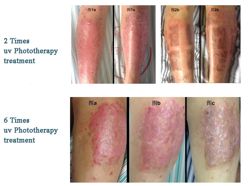 Use Nb Uvb To Treat Psoriasis
