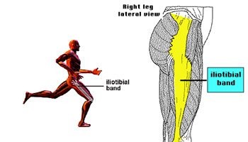 Iliotibial Band Syndrome and Physiotherapy