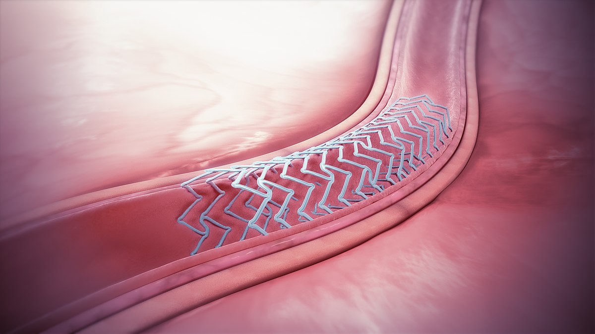 Bioabsorbable Stents: Are Newest Innovations In the Field of Medical Technology