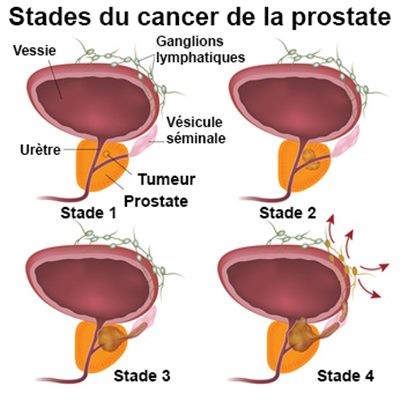 Cancer de la prostate et des testicules: dépasser le tabou