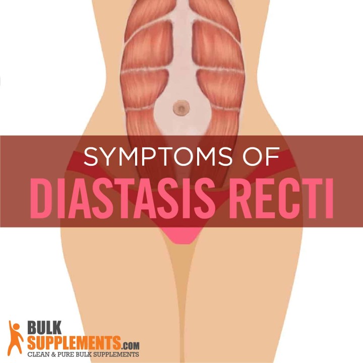 Diastasis Recti: Symptoms, Causes & Treatment