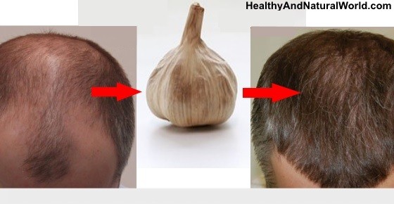 Garlic For Promote Hair Growth