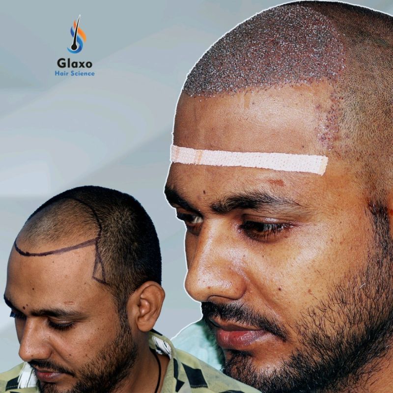 IFT hair science india - Laser and hair transplant clinic - Glaxo hair  science | LinkedIn