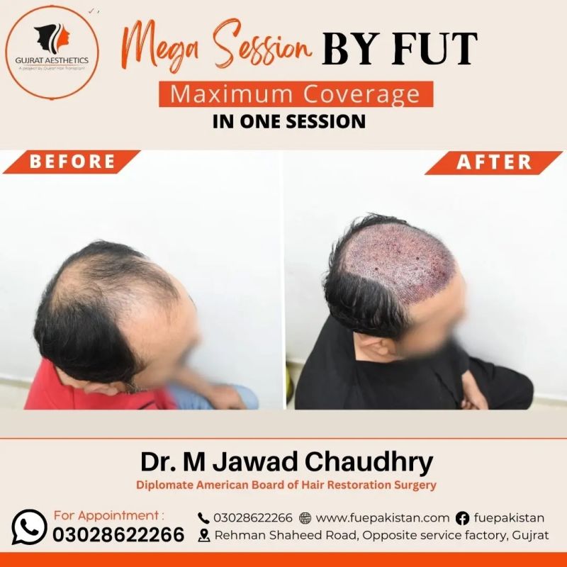 Mubashsher Muhammed - Hair Transplant Surgeon - Precision Hair clinic |  LinkedIn