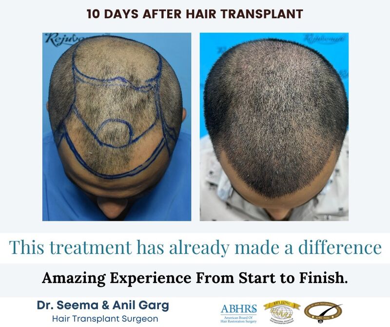 Bittu Kumar - Hair transplant - HAIR & SKIN | LinkedIn
