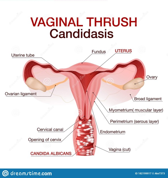 Vaginal Candidiasis