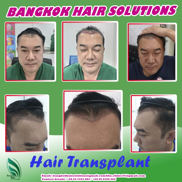 Hair Transplant by Bangkok Hair Solutions!!
