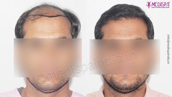 How To Choose The Best Hair Transplant Clinic In Noida?