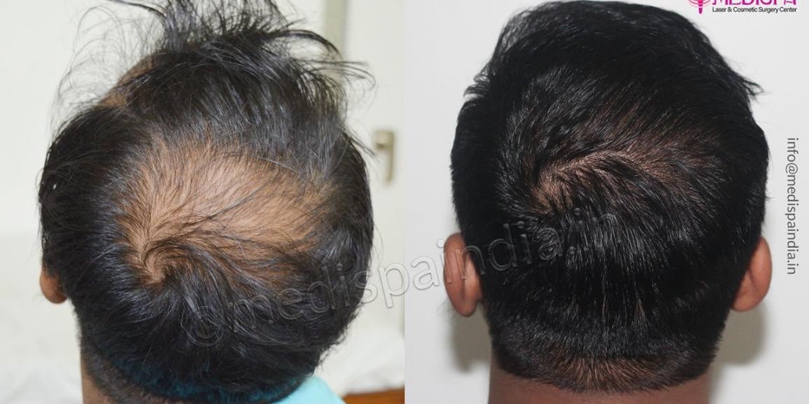 Should I Undergo Second Hair Transplant After The Unsuccessful Surgery?