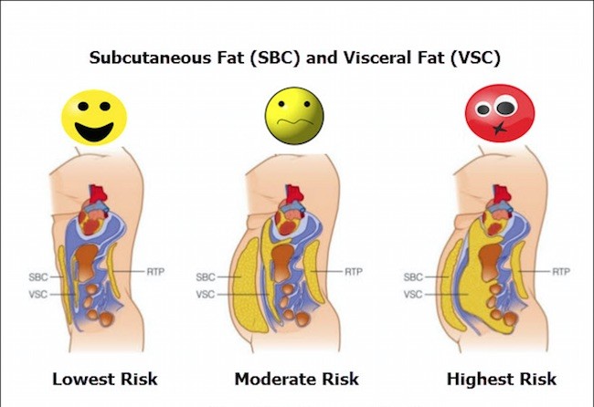 The Dangers of Visceral (Intra-abdominal) Fat vs. Subcutaneous Fat:
