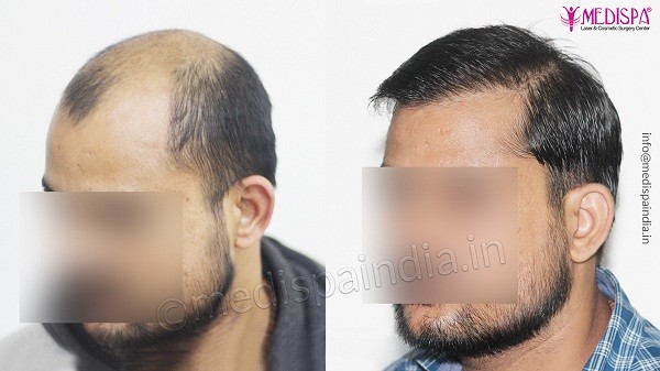 Best Ways To Find The Top Hair Transplant Surgeon in South Delhi