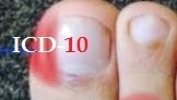 Billing Ingrown Nail under the new ICD-10 Codes