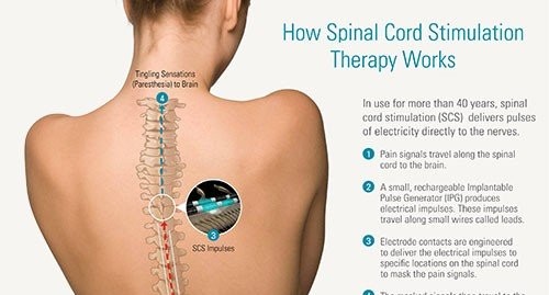 Why Do I Need A Psychological Screening for Spinal Cord Stimulation?