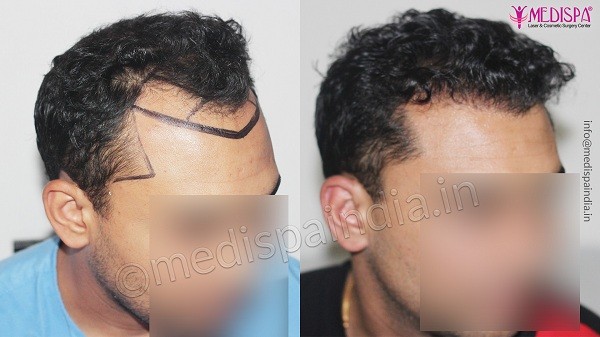 Best Ways To Get Cost-Efficient Hair Transplant in Gurgaon