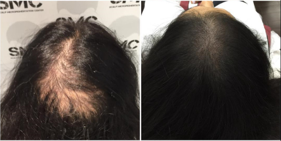 Why Hair Transplant Clinics Need To Add Scalp Micropigmentation (SMP) As A  Treatment Option.