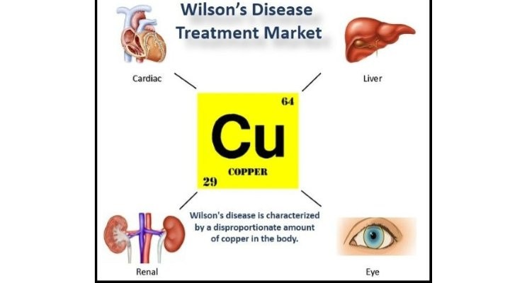 Wilson's disease treatment market - know the potential of this silent rare disease