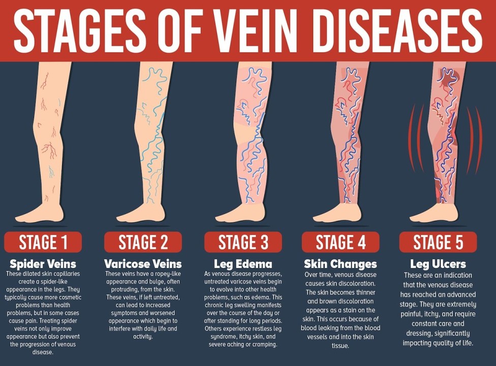 What are varicose veins? Prevention