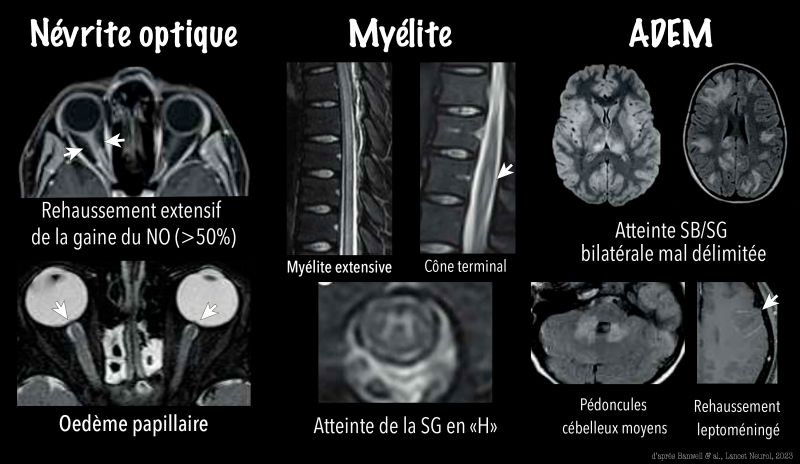 Gilles Brun sur LinkedIn : #mogad #sep #nmo #neurorad #neurology