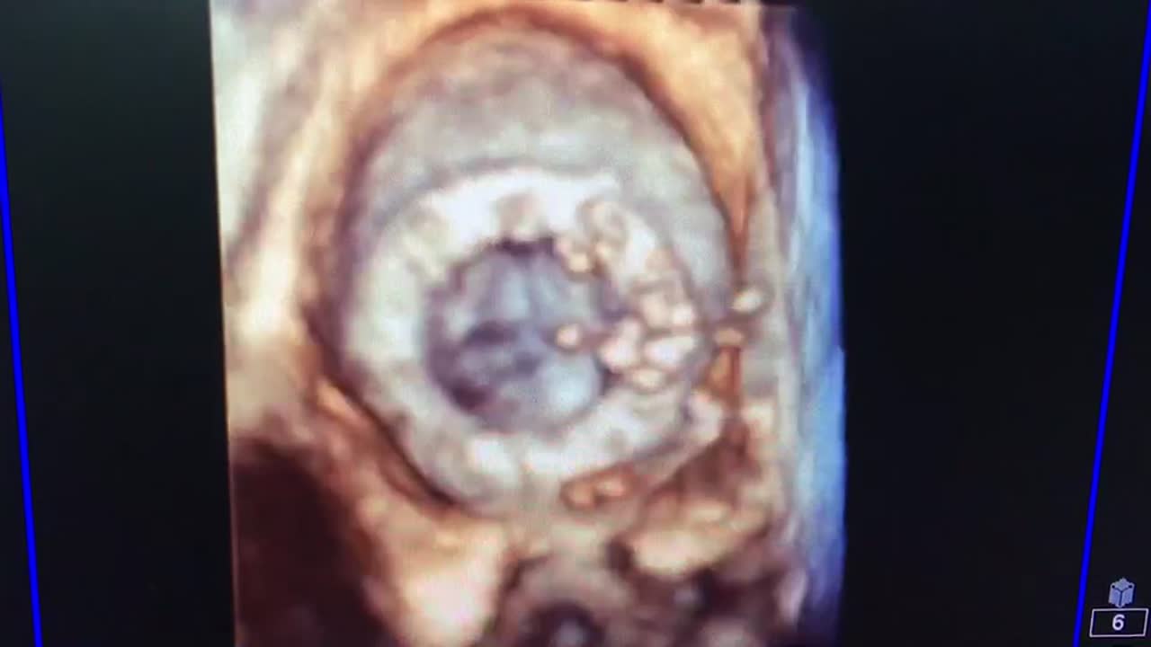 Vikas Khadse on LinkedIn: Perioperative bioprosthetic mitral valve in Vikas Khadse on LinkedIn: Perioperative bioprosthetic mitral valve in