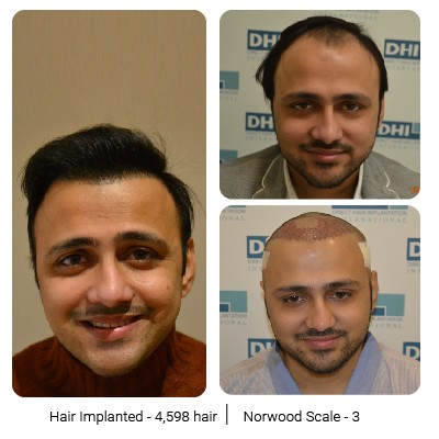 DHI Hair Transplant Journey of a Young Business Owner