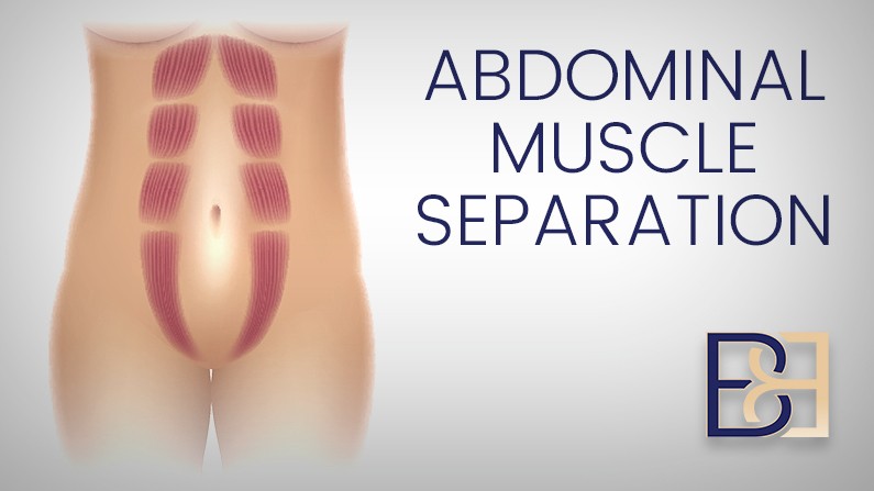 How to Fix Abdominal Muscle Separation (diastasis recti) after