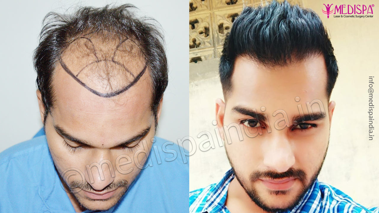 How to decide the Average Hair Transplant Cost in Toronto