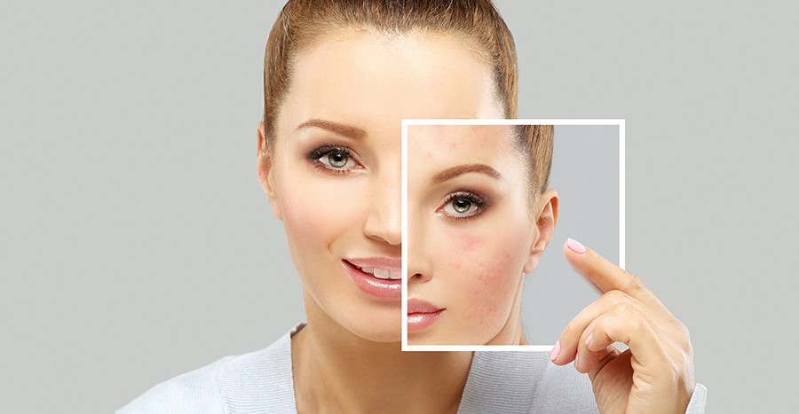 Benefits of Fractional CO2 Laser Skin Resurfacing
