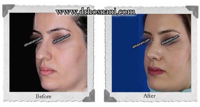 A better lip-nose contour and more refined nasal tip were achieved during  this nose job