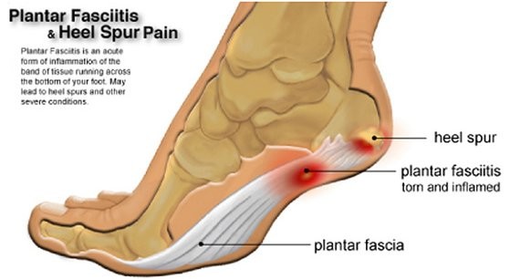 On Heel Pain - Plantar Fasciitis