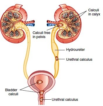 Renal Calculi / Kidney Stones
