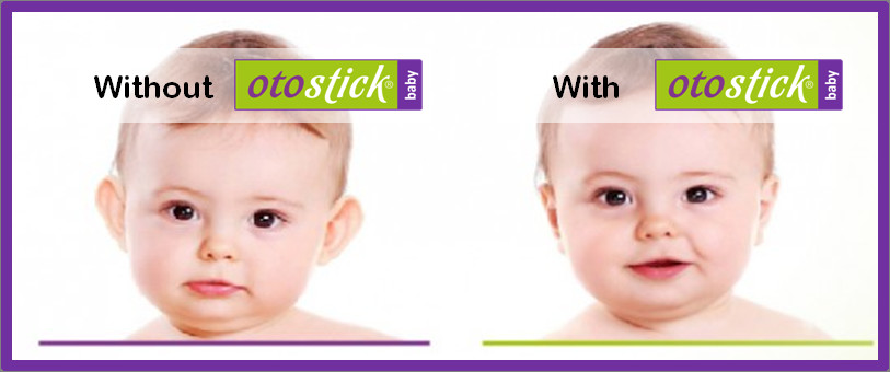 Otostick Baby - An instant and long-term non-surgical solution for