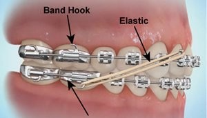 What role do elastics (rubber bands) play in Orthodontics?