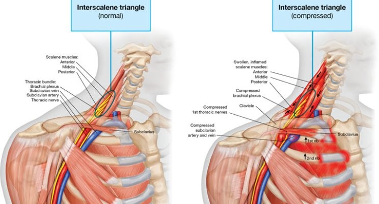 injury blog: thoracic outlet syndrome