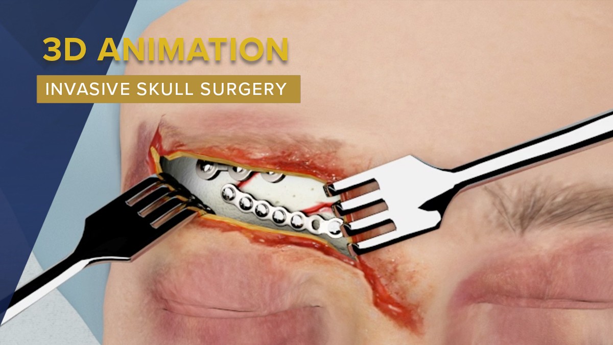 3D Animation Used To Display Invasive Skull Surgery