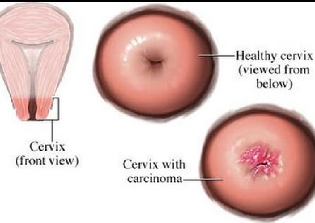 Human Papilloma Virus and Cervical Cancer