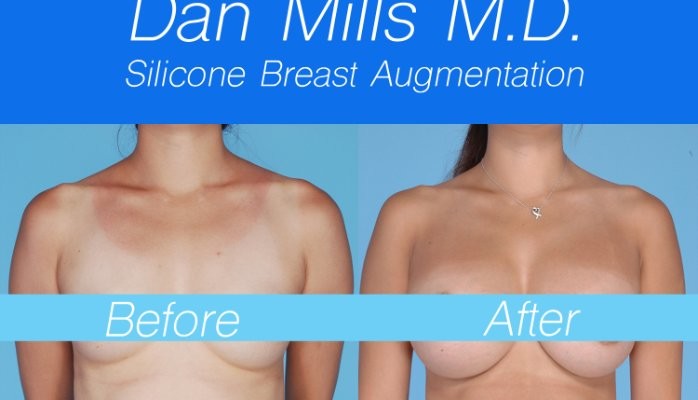 Breast Augmentation By Dan Mills M.D.
