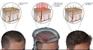 Low level laser therapy and hair regrowth: an evidence-based review.