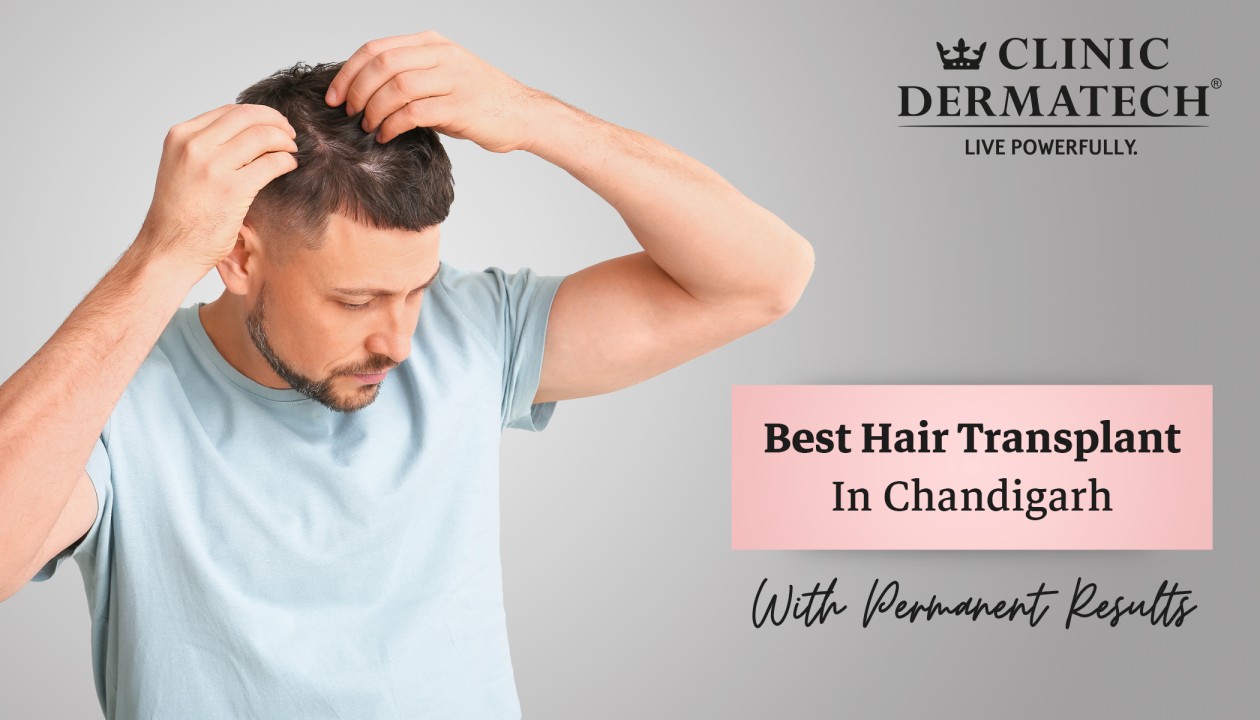 Hair Transplant In Chandigarh: Cost, Techniques And Benefits