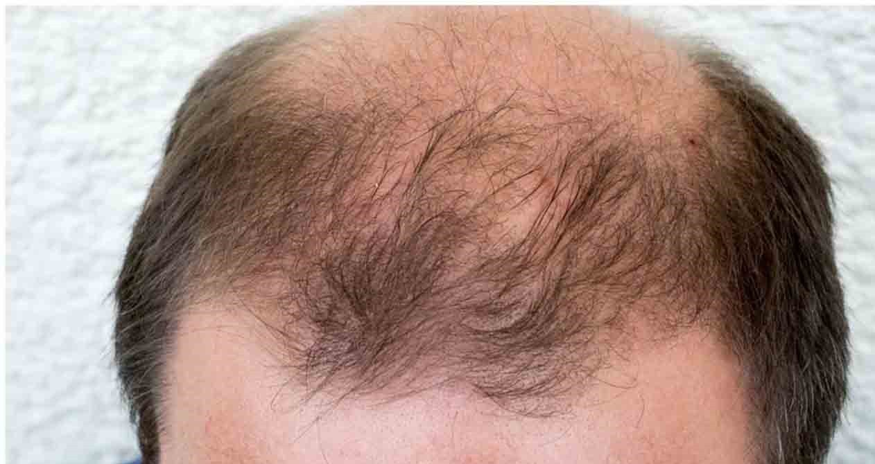 HOMEOPATHY FOR GREY HAIR