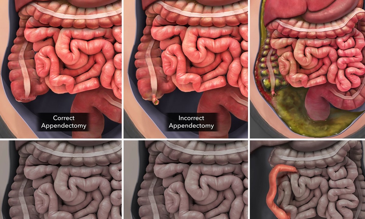 7-Figure Settlement: Animated Appendix Rupture