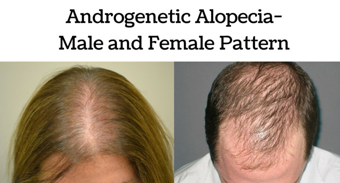 Androgenetic Alopecia