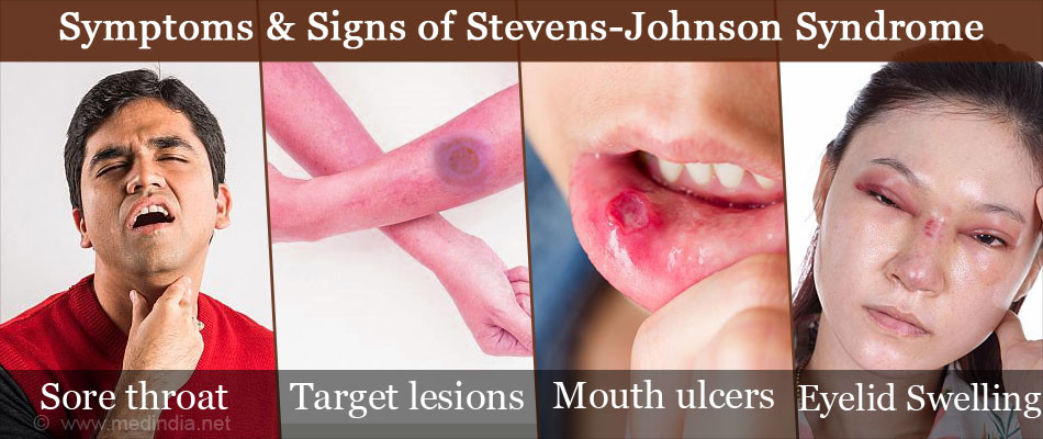 🤕Stevens-Johnson Syndrome: What is it?🤔