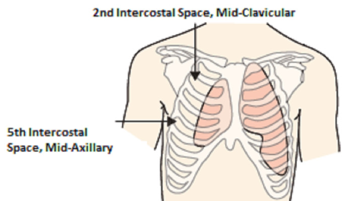 Tension Pneumothorax: Want to get something off your chest?