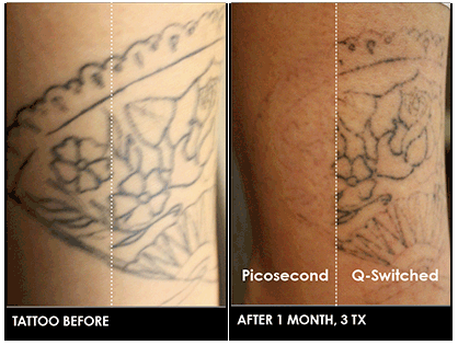 Flygtig Brandmand respons Does Tattoo Removal Leave Scars?