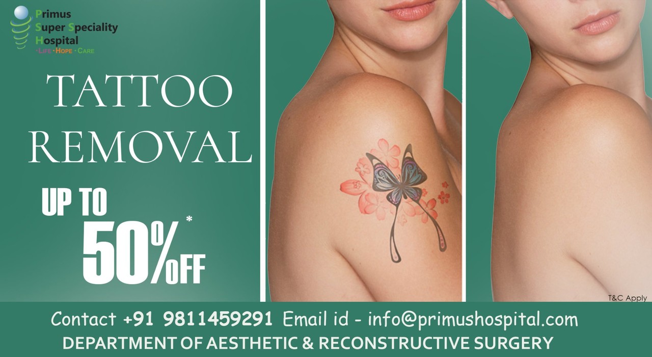 Best Tattoo Removal Hospital in Delhi