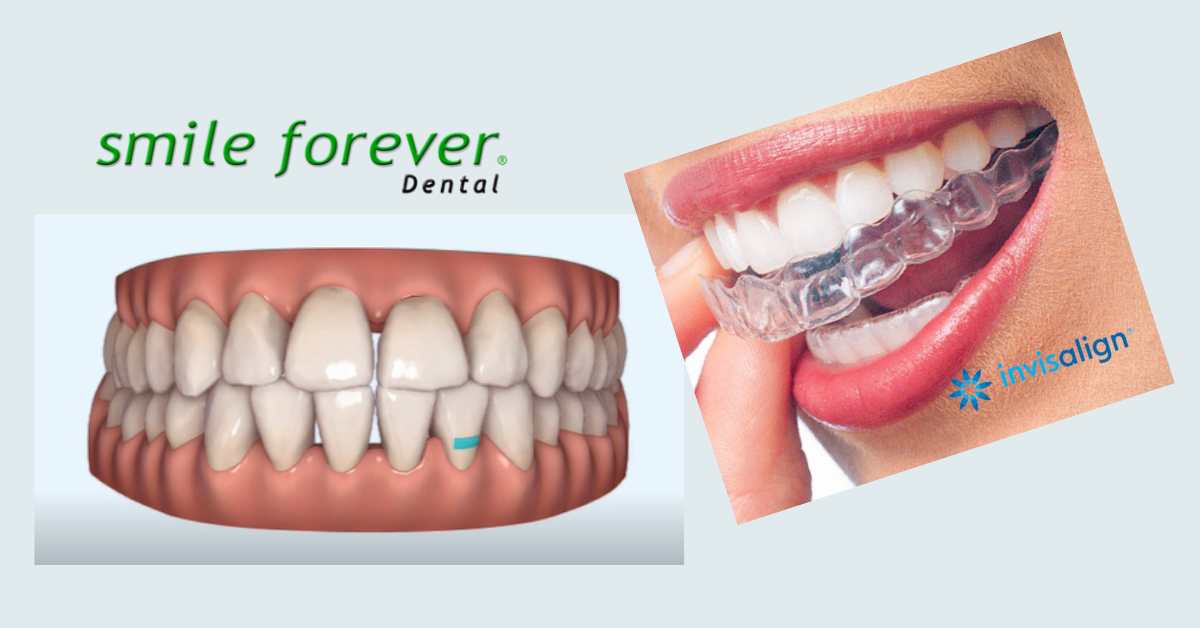 Invisalign Invisible Braces: a virtually invisible system to straighten  teeth.