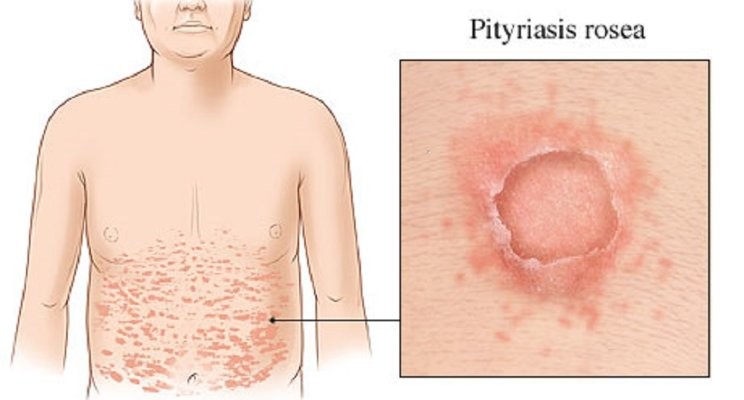 pityriasis rosea-skin rash