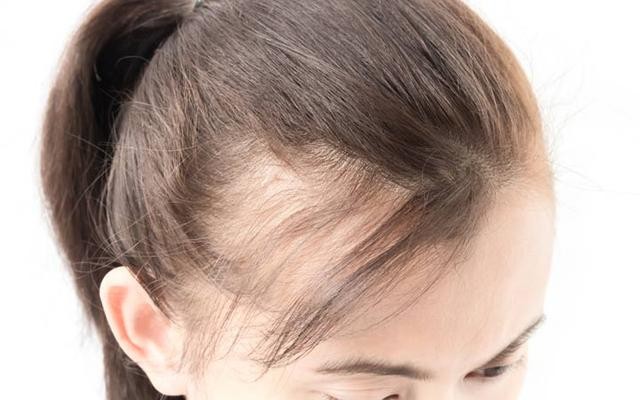 HOMEOPATHY FOR HAIR LOSS IN WOMEN
